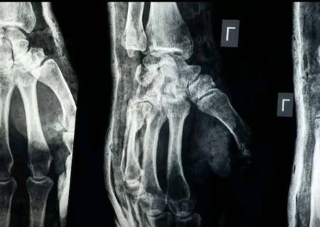 دستاورد بزرگ پژوهشگران چینی؛ تولید چسب استخوانی که می‌تواند جراحی‌های ارتوپدی را متحول کند
